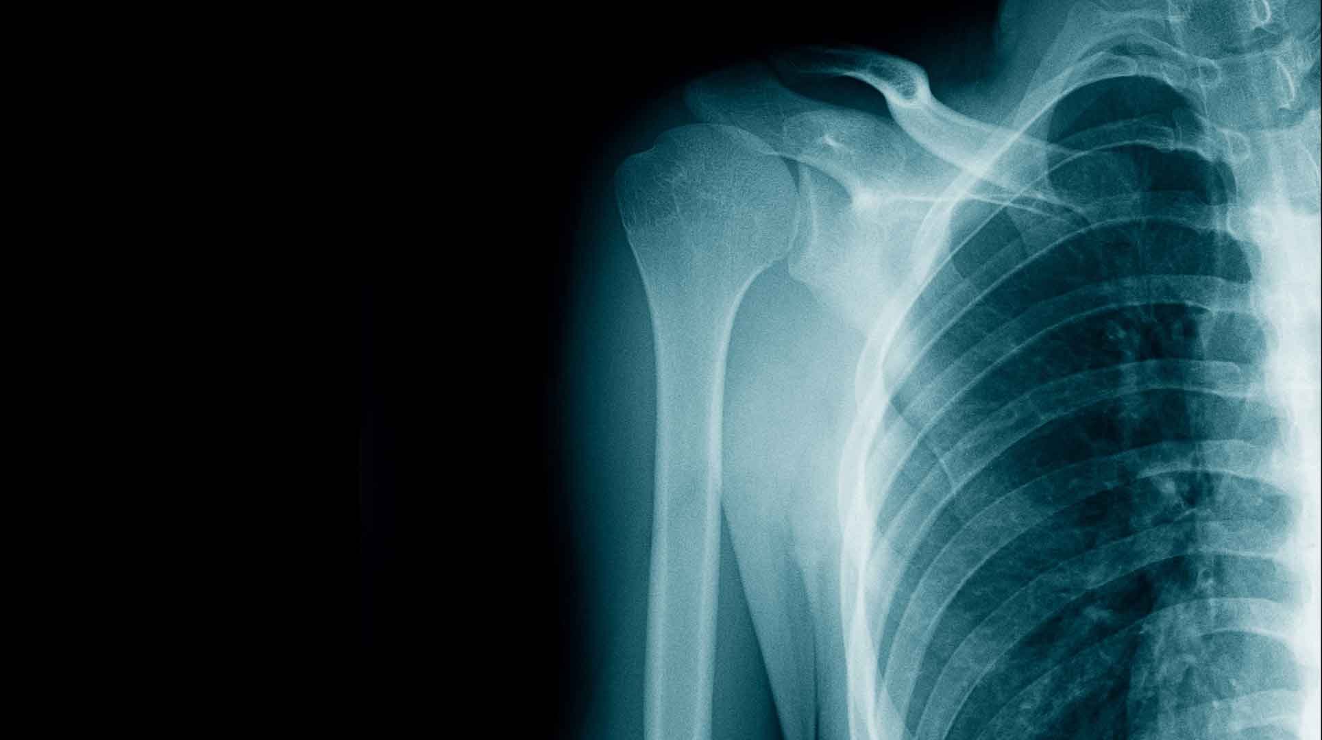 X-ray of shoulder